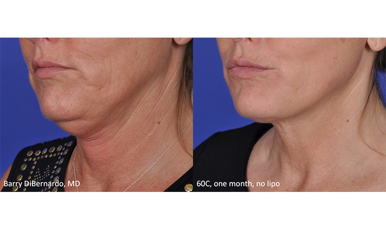 Barry-DiBernardo_1-Month_No-Lipo