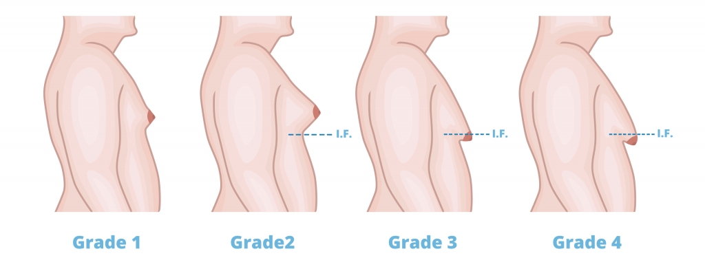 Male Breast Reduction for Gynecomastia in Orlando, FL - DrGeorge Pope